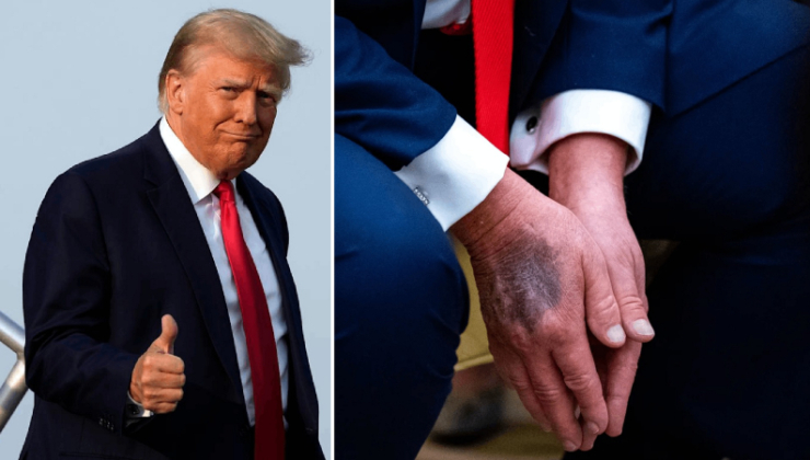 ABD Başkanı Trump elindeki morlukların sebebini açıkladı: ‘Batıl inançlara sahibim’