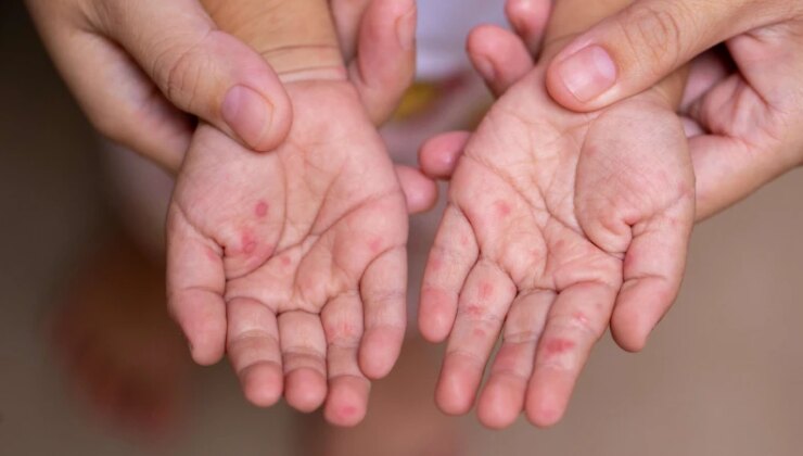 Kızamık alarmı: İngiltere’de iki çocuk hayatını kaybetti